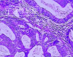 子宫腺肌症
