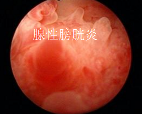 腺性膀胱炎