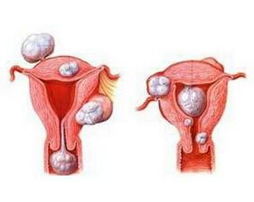 子宫腺肌症最新治疗