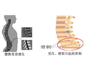 骨质增生的原因是什么