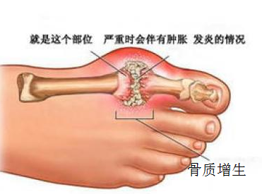 足部骨质增生的治疗