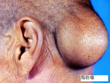 脂肪瘤预防