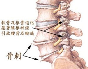 骨质增生病因