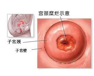 宫颈糜烂是怎么引起的