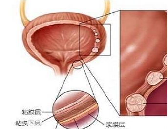 腺性膀胱炎的偏方