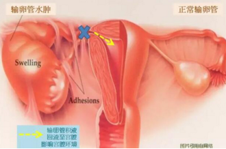 输卵管积水的治疗