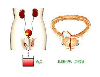 前列腺肥大晚期症状尿潴留