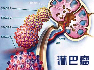 淋巴瘤的治疗