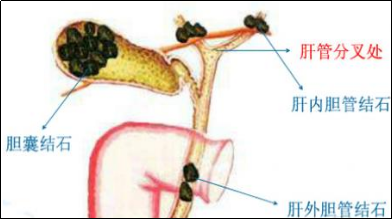 胆囊结石的症状