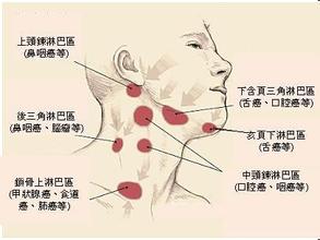 颈部淋巴瘤的早期症状