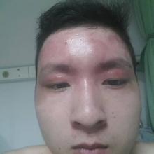 皮肤烧伤怎么恢复?