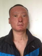 皮肤烧伤怎么恢复?