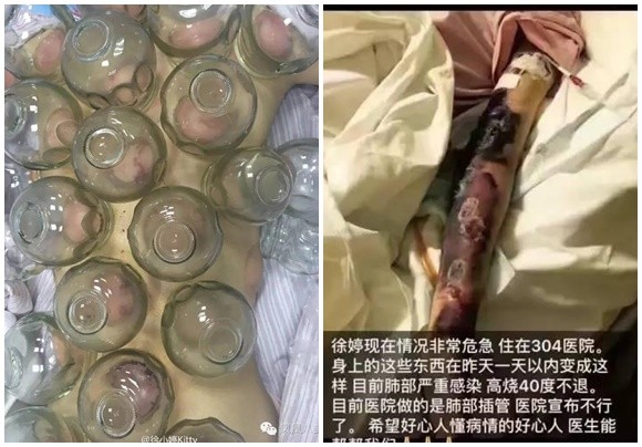 徐婷生前中医治疗癌症