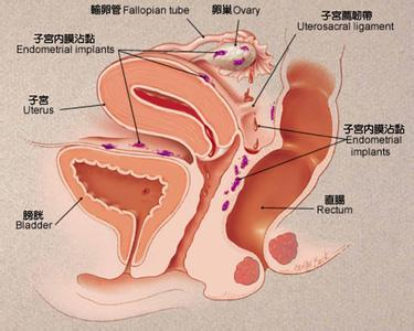 子宫内膜异位症病因