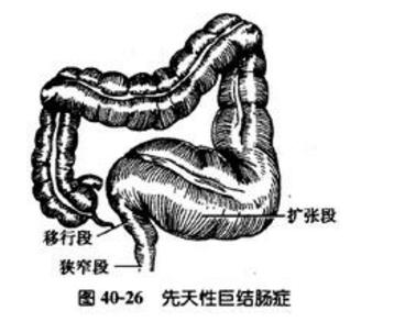 先天性巨结肠症