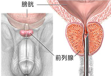 慢性前列腺炎的自我疗法