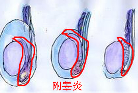 睾丸肿大疼痛附睾炎怎么治