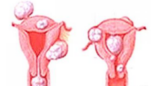 子宫腺肌症该怎么办