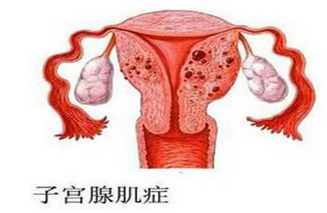 子宫腺肌症该怎么办