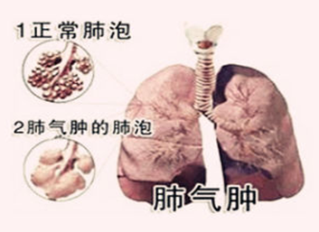 肺气肿