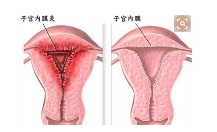 子宫内膜炎