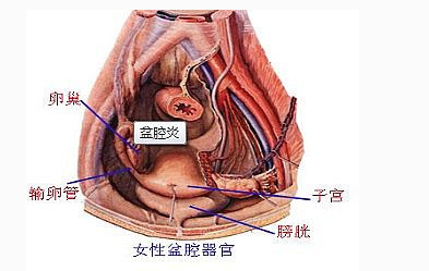 盆腔炎性疾病常见病因有哪些