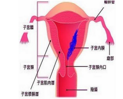 易患子宫内膜癌的8类高危人群