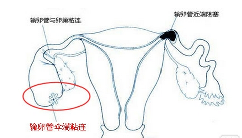 输卵管伞部粘连术后不孕怎么治疗