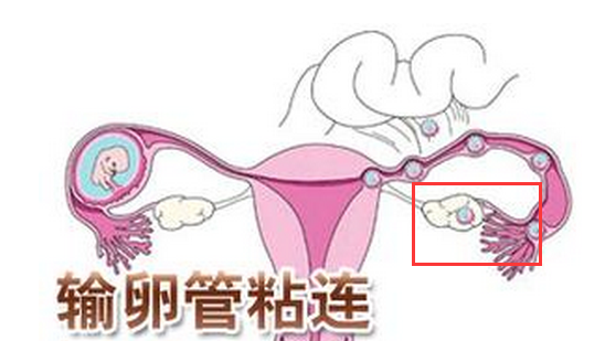 输卵管伞部粘连术后不孕怎么治疗