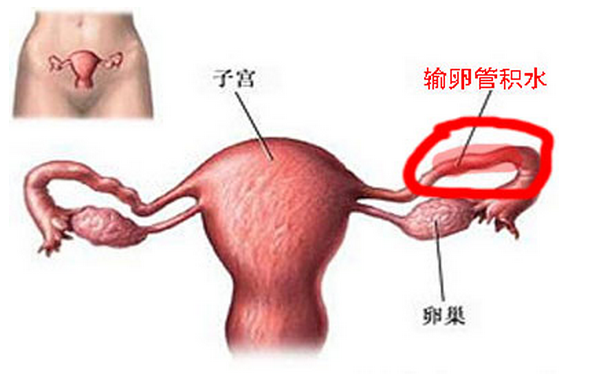 输卵管积水怎么治疗