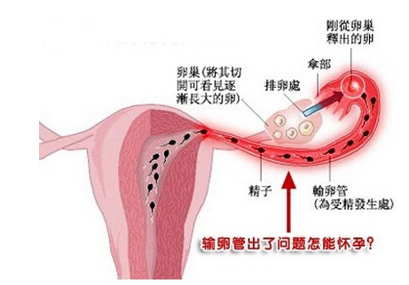 输卵管双侧不通不孕怎么治疗