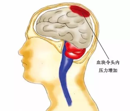 冬季预防脑血管病