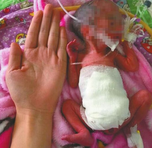 成都女婴仅巴掌大