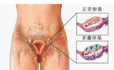 多囊性卵巢疾病