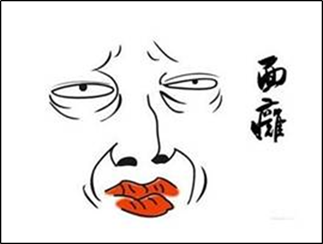 面瘫