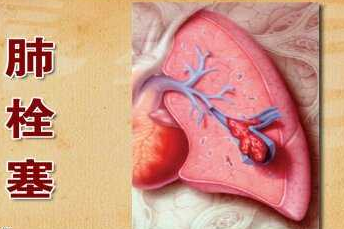 肺栓塞都有哪些症状？