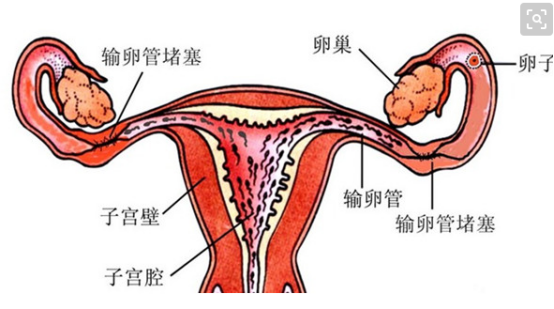 输卵管堵塞自测