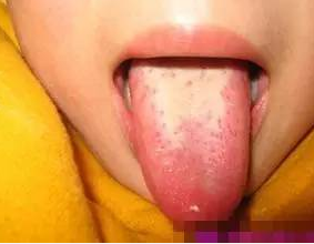 孩子咳嗽老不好怎么办