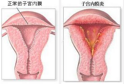 子宫内膜炎症状表现