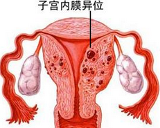 子宫内膜异位症的治疗