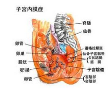 子宫内膜炎吃什么药效果好