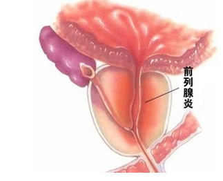 前列腺炎的常见误区有哪些