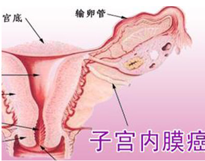 子宫内膜癌的高危人群