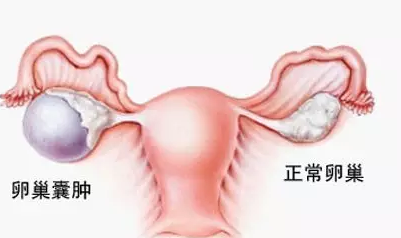 卵巢囊肿的危害