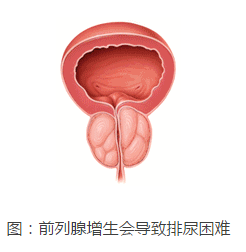 前列腺炎的治疗