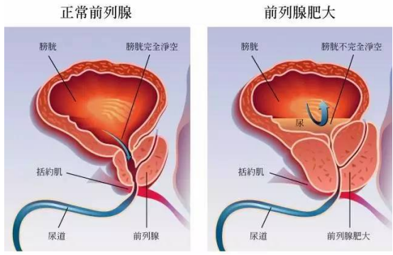 前列腺炎的治疗