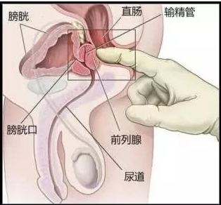 前列腺炎的治疗