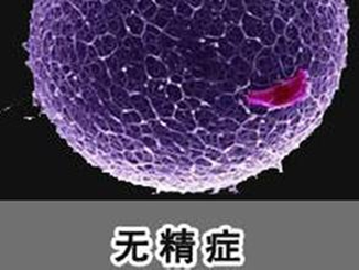 无精症