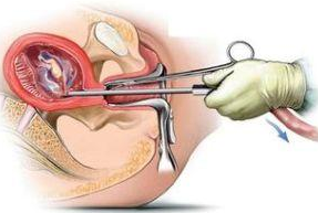 人工流产手术会引发子宫内膜炎吗
