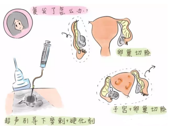 子宫内膜异位症复发怎么办？